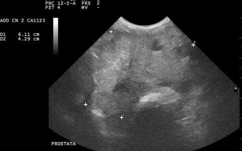 Ipertrofia prostatica benigna